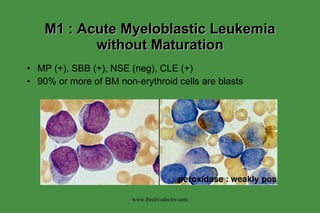 M1 : Acute Myeloblastic Leukemia without Maturation MP (+), SBB (+), NSE (neg), CLE (+) 90% or more of BM non-erythroid cells are blasts www.freelivedoctor.com 