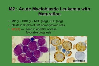 M2 : Acute Myeloblastic Leukemia with Maturation MP (+), SBB (+), NSE (neg), CLE (neg) blasts in 30-9% of BM non-erythroid cells t(8;21)  --- seen in 40-50% of case favorable prognosis www.freelivedoctor.com 