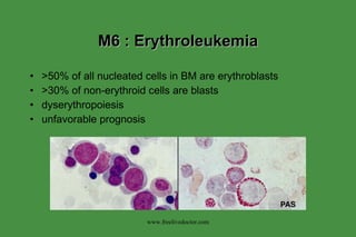 M6 : Erythroleukemia >50% of all nucleated cells in BM are erythroblasts >30% of non-erythroid cells are blasts dyserythropoiesis unfavorable prognosis www.freelivedoctor.com 