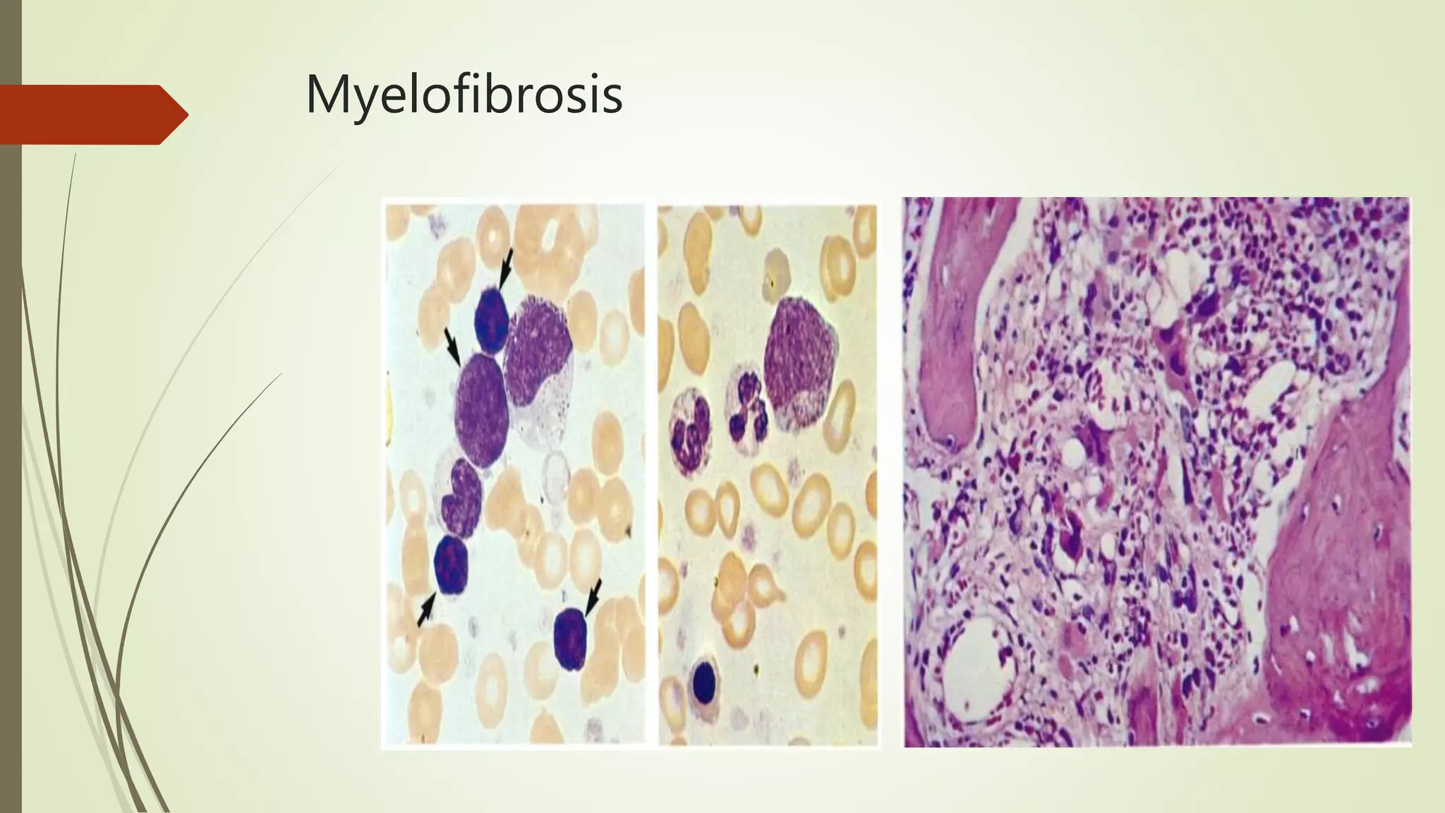 Myeloproliferative Neoplasms | PPTX