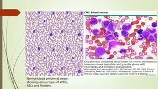 Normal blood peripheral smear,
showing various types of WBCs,
RBCs and Platelets.
 