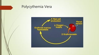 Polycythemia Vera
 