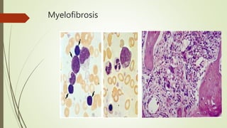 Myelofibrosis
 