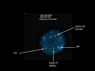 bcr
abl
fusion 9
abl/bcr
fusion 22
bcr/abl
 