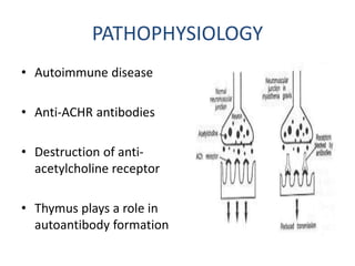 PATHOPHYSIOLOGY
• Autoimmune disease
• Anti-ACHR antibodies
• Destruction of anti-
acetylcholine receptor
• Thymus plays a role in
autoantibody formation
 