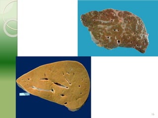 Molecular mechanism of drug induced hepatotoxicity | PPTX