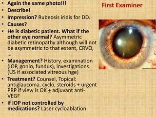 Subtle Rubeosis My experience in FRCS Glasgow ophthalmology | PPTX