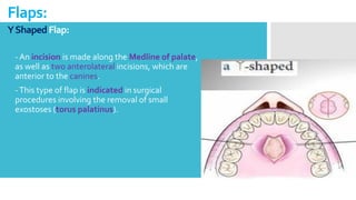 YShapedFlap:
Flaps:
- An incision is made along the Medline of palate,
as well as two anterolateral incisions, which are
anterior to the canines.
-This type of flap is indicated in surgical
procedures involving the removal of small
exostoses (torus palatinus).
 