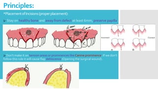 *PlacementofIncisions(properplacement):
1- Stay on healthy bone and away from defect at least 6mm, preserve papilla.
Principles:
2-Don’t make it on tension areas or prominences like Canine prominence. If we don’t
follow this rule it will cause flap dehiscence (Opening the surgical wound).
 