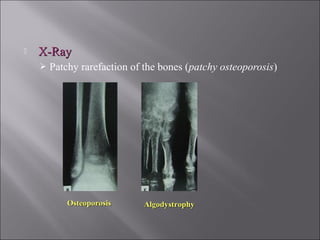  X-RayX-Ray
 Patchy rarefaction of the bones (patchy osteoporosis)
OsteoporosisOsteoporosis AlgodystrophyAlgodystrophy
 