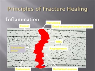 Inflammation
Periost
Devitalized marrowEndosteum
Hematoma
Dead osteocytes/empty lacunae
WBC
AngiogenesisGranulation
tissue
 