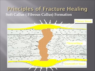 Soft Callus ( Fibrous Callus) Formation
Granulation tissue
Fibrous tissue
Fibrocartilage
 