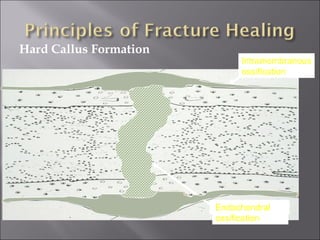 Hard Callus Formation
Fibrous tissueIntramembranous
ossification
FibrocartilageEndochondral
ossification
 