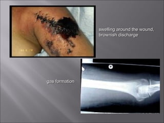 
swelling around the wound,swelling around the wound,
brownish dischargebrownish discharge
gas formationgas formation
 
