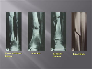 Severe soft tissueSevere soft tissue
damagedamage
InfectionInfection ExcessiveExcessive
tractiontraction
Intact fibulaIntact fibula
 