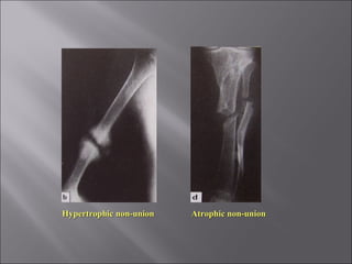 Hypertrophic non-unionHypertrophic non-union Atrophic non-unionAtrophic non-union
 