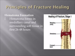 Hematoma Formation
 Hematoma forms in
medullary canal and
surrounding soft tissue in
first 24-48 hours
 