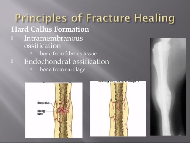 My fracture healing