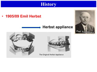 History
• 1905/09 Emil Herbst
Herbst appliance
 