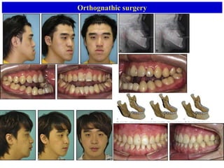 Orthognathic surgery
 
