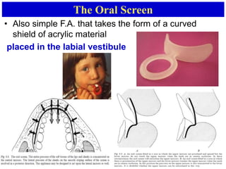 The Oral Screen
• Also simple F.A. that takes the form of a curved
shield of acrylic material
placed in the labial vestibule
 