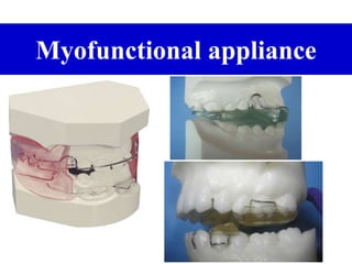 Myofunctional appliance
 
