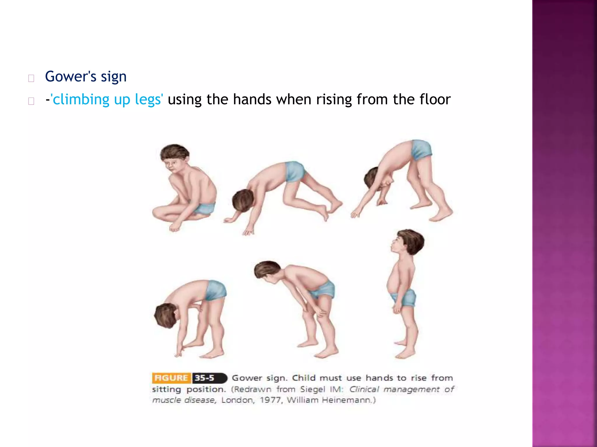Gower's sign 
-'climbing up legs' using the hands when rising from the floor 
 