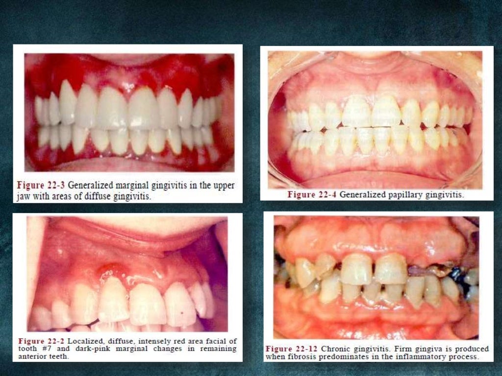 CLINICAL FEATURES OF GINGIVITIS AND ITS CORRELATION WITH MICROSCOPIC