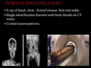 X ray of hand, chest , frontal sinuses ,foot and ankle.
Single identification features with bony details on CT
scans.
Cranial suture patterns.
 