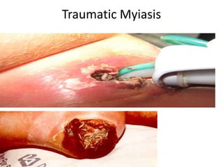 Traumatic Myiasis
• aa

 