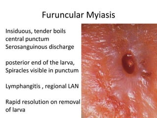 Furuncular Myiasis
Insiduous, tender boils
central punctum
Serosanguinous discharge
posterior end of the larva,
Spiracles visible in punctum
Lymphangitis , regional LAN
Rapid resolution on removal
of larva

 