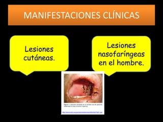 MANIFESTACIONES CLÍNICAS
Lesiones
cutáneas.
Lesiones
nasofaríngeas
en el hombre.
 