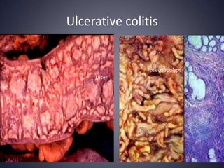 Ulcerative colitis


                pseudopolyps
     Ulcer
 