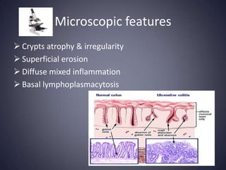 Microscopic features
 Crypts atrophy & irregularity
 Superficial erosion
 Diffuse mixed inflammation
 Basal lymphoplasmacytosis
 