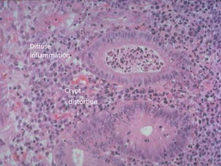 Diffuse
inflammation



          Crypt
           distortion
 