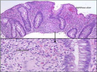 Aphthous ulcer




Granuloma
 