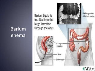 Barium
enema
 