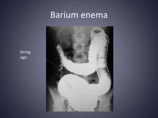Barium enema


String
sign
 