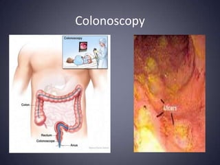 Colonoscopy
 