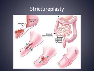Strictureplasty
 