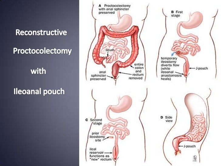 Inflammatory bowel disease