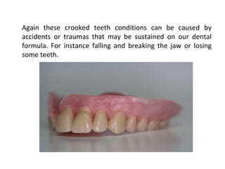Again these crooked teeth conditions can be caused by
accidents or traumas that may be sustained on our dental
formula. For instance falling and breaking the jaw or losing
some teeth.
 