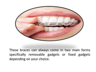 These braces can always come in two main forms
specifically removable gadgets or fixed gadgets
depending on your choice.
 