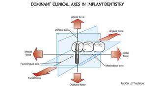 Implant occlusion | PPTX