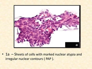• 1a – Sheets of cells with marked nuclear atypia and
irregular nuclear contours ( PAP ).
 