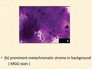• (b) prominent metachromatic stroma in background
( MGG stain )
 