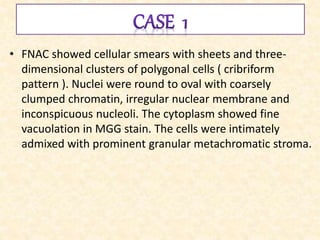 • FNAC showed cellular smears with sheets and three-
dimensional clusters of polygonal cells ( cribriform
pattern ). Nuclei were round to oval with coarsely
clumped chromatin, irregular nuclear membrane and
inconspicuous nucleoli. The cytoplasm showed fine
vacuolation in MGG stain. The cells were intimately
admixed with prominent granular metachromatic stroma.
 