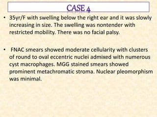 • 35yr/F with swelling below the right ear and it was slowly
increasing in size. The swelling was nontender with
restricted mobility. There was no facial palsy.
• FNAC smears showed moderate cellularity with clusters
of round to oval eccentric nuclei admixed with numerous
cyst macrophages. MGG stained smears showed
prominent metachromatic stroma. Nuclear pleomorphism
was minimal.
 