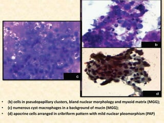 • (b) cells in pseudopapillary clusters, bland nuclear morphology and myxoid matrix (MGG);
• (c) numerous cyst macrophages in a background of mucin (MGG);
• (d) apocrine cells arranged in cribriform pattern with mild nuclear pleomorphism (PAP)
 