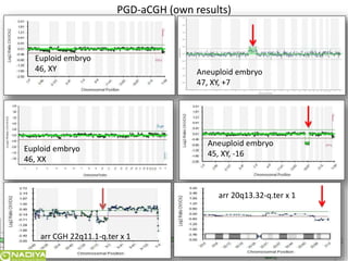 16 
PGD-aCGH (own results) 
Euploid embryo 
46, XY Aneuploid embryo 
47, XY, +7 
Euploid embryo 
46, XX 
Aneuploid embryo 
45, XY, -16 
arr CGH 22q11.1-q.ter x 1 
arr 20q13.32-q.ter x 1 
 